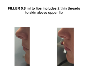 Lip fillers