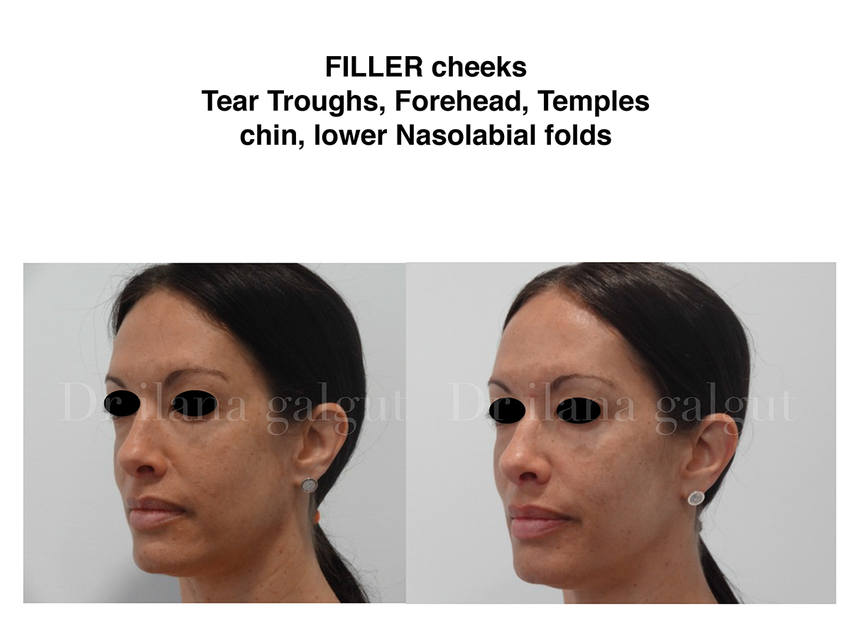Fillers - Cheeks, Forehead, Temples, Chin