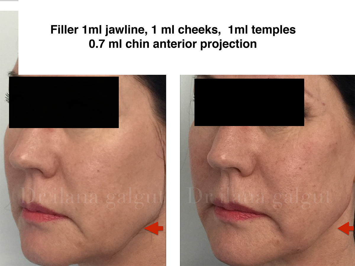 Fillers - Jawline, cheeks, temples, chin