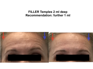 Temple fillers