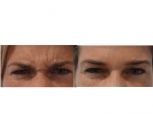 Antiwrinkle Before and After